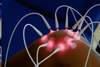  3B Laser Needle 